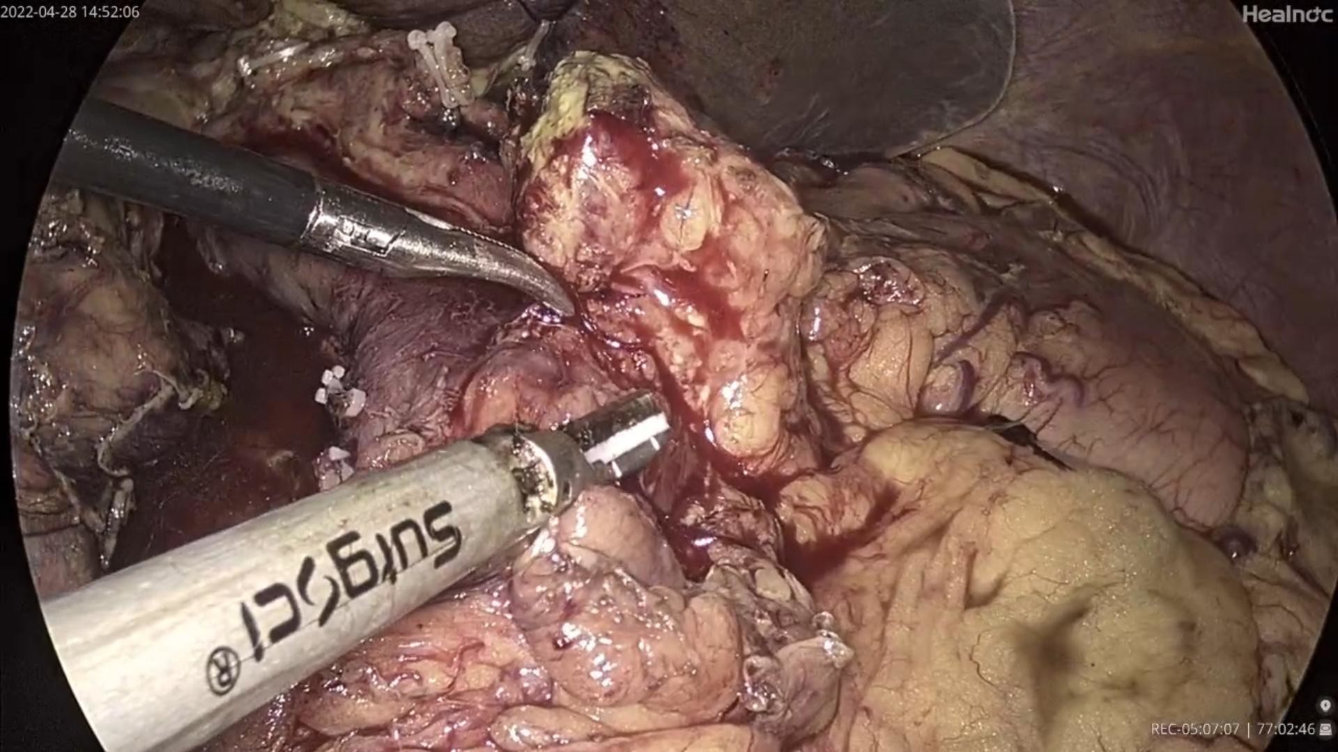 Latest company case about The Use of Surgsci's Ultrasonic Scalpel in Laparoscopic Gallbldder-Preserving Surgery (2)