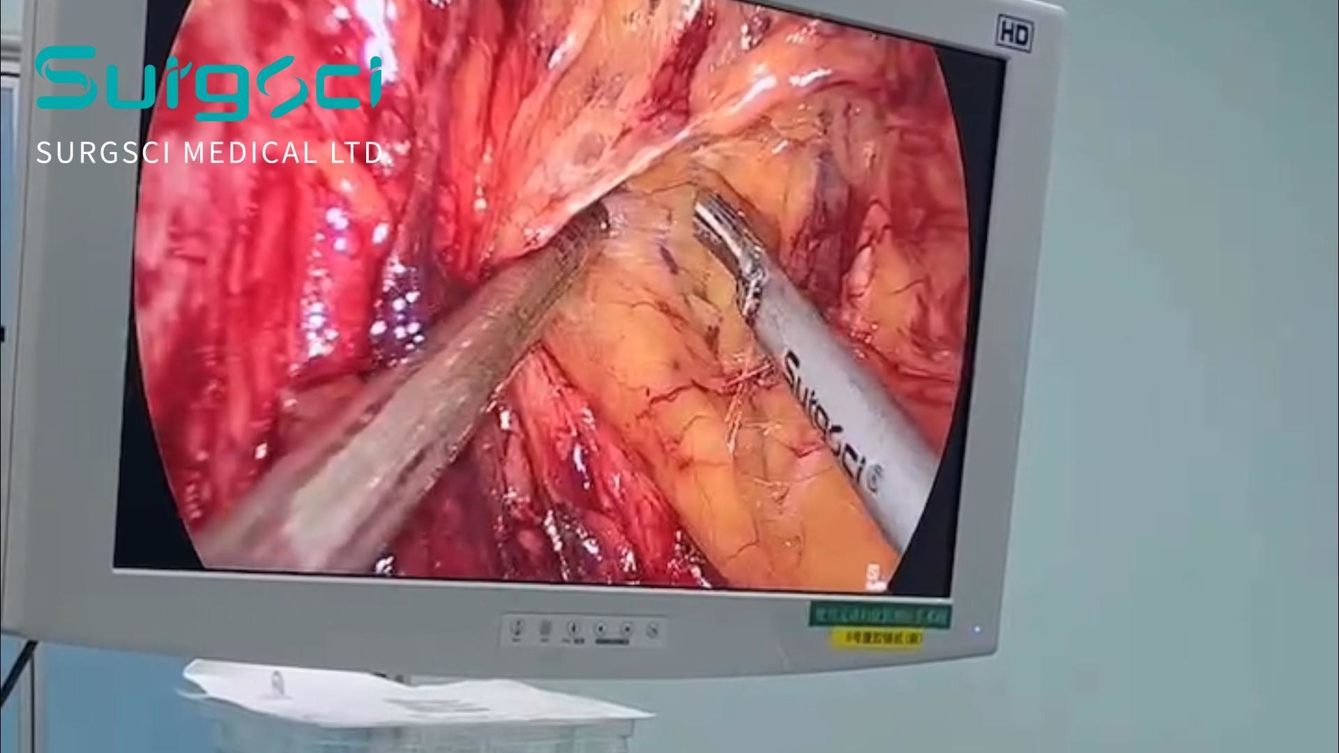 Latest company case about Laparoscopic Radical Prostatectomy in the People’s Hospital of Gaozhou | Ultrasonic Scalpel Use Case