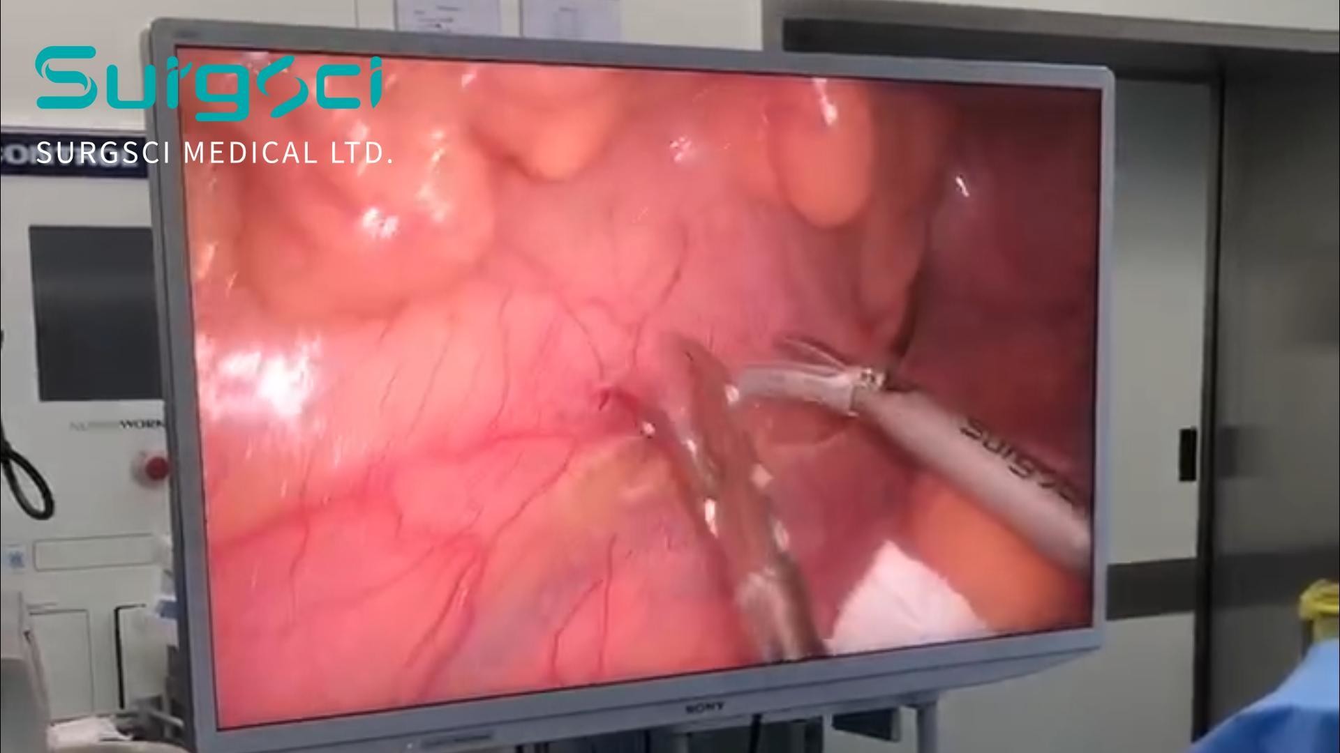 Latest company case about Laparoscopic Radical Resection of Rectal Cancer with Surgsci Ultrasonic Scalpel