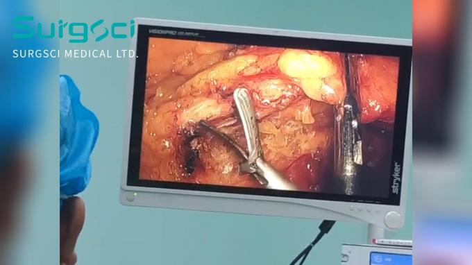 latest company case about Laparoscopic Sigmoidectomy with Surgsci Ultrasonic Scalpel at GuiDong People's Hospital of Guangxi Autonomous | Surgsci 0
