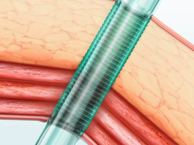 latest company news about The Features And Benefit Of Endopass Disposable Laparoscopic Trocar | SurgSci  0