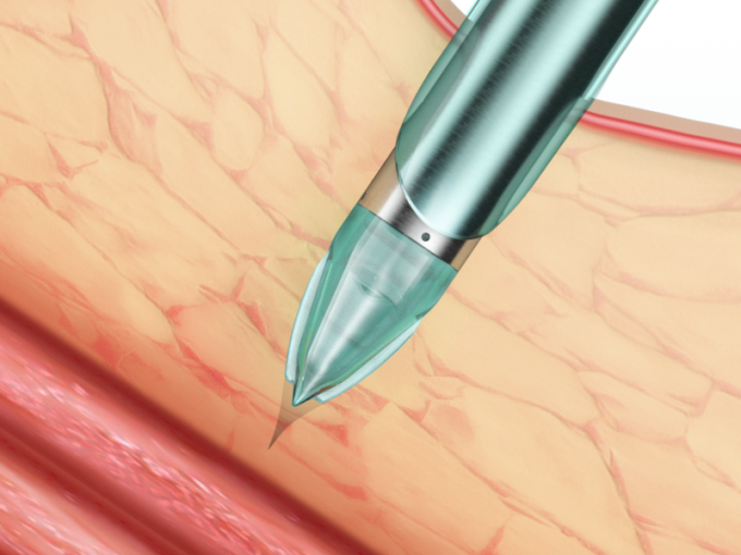 latest company news about The Features And Benefit Of Endopass Disposable Laparoscopic Trocar | SurgSci  1