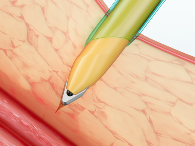 Laparoscopic Instruments Disposable Trocar Cannula With Blade Surgical Medical 1