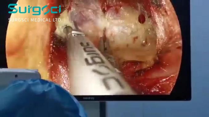 latest company news about Ultrasonic Scalpel Application Video| Laparoscopic Thyriod Lesion Removal | Surgsci  0