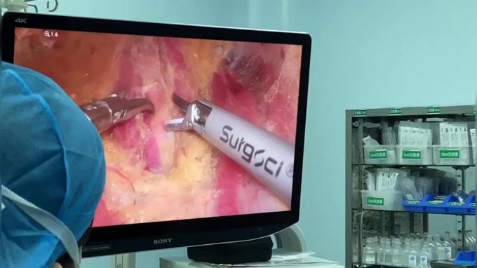 latest company case about Ultrasonic Scalpel in Use | Laparoscopic bilateral thyroidectomy | Surgsci  0
