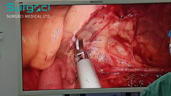 latest company case about Radical Surgery For Left Colon And Rectal Cancer | Surgsci  0