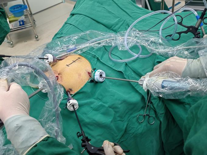 latest company case about SurgSci Laparoscopic Trocar and Ultrasonic Scalpel Use Case | Surgsci  1