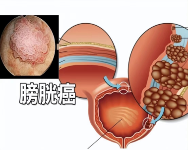 latest company news about Clinical Diagnosis And Physiological Care Of Bladder Cancer | Surgsci  0