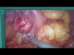 Laparoscopic Retroluminal Tumor Resection | Ultrasonic Scalpel Using Cases